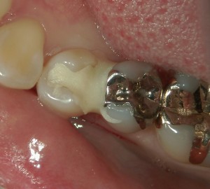 セラミックス　審美治療　精密歯科治療　千石　茗荷谷　高橋　歯科　クリニック