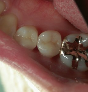 精密歯科治療、歯を守る治療、茗荷谷、千石　高橋歯科クリニック文京