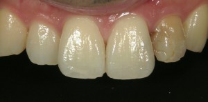 茗荷谷　千石　新大塚　歯医者　高橋歯科クリニック文京　審美治療