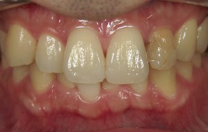 審美治療　精密根管治療　拡大鏡を用いた精密審美　高橋歯科クリニック文京