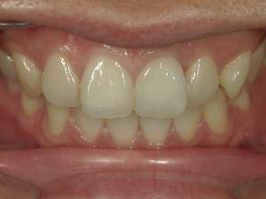 高橋歯科クリニック文京 審美治療 高橋歯科クリニック文京 茗荷谷 千石 新大塚 護国寺