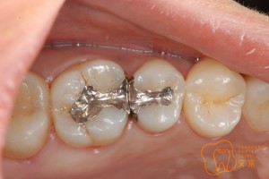 高橋歯科クリニック文京　審美治療　セラミックスインレー　