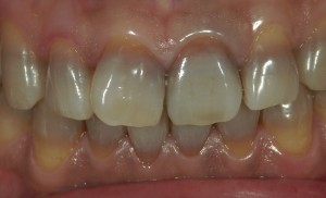 高橋歯科クリニック文京　セラミックス治療　審美治療　