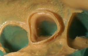 高橋歯科クリニック文京シリコン印象