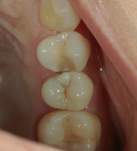 高橋歯科クリニック文京　ハイブリッドインレー