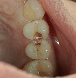 高橋歯科クリニック文京　ハイブリッドインレー