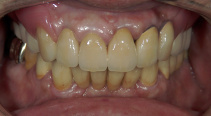 文京区茗荷谷かみ合わせ入れ歯治療