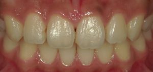 矯正治療後の歯間　不適合なプラスチック