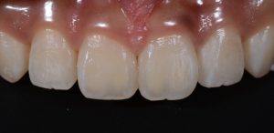 不適合なプラスチックの再治療